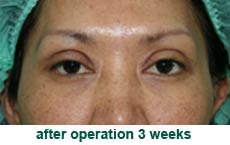 plastic-surgery-blepharoplasty